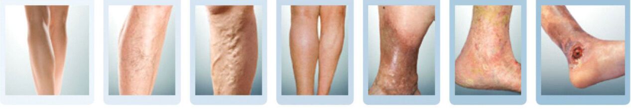 developmental stages of leg varicose veins