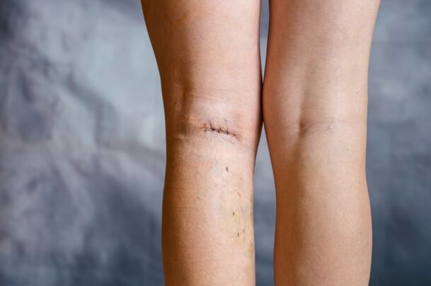 suturing the leg after surgery varicose veins