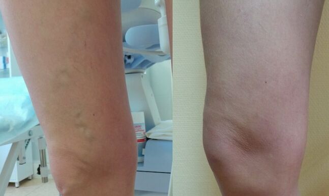 feet before and after treatment of reticular varicose veins
