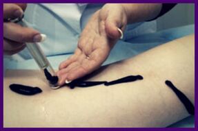 Procedure for treating varicose veins with leeches (hirudotherapy)