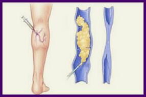 Sclerotherapy is a popular way to get rid of varicose veins in the legs