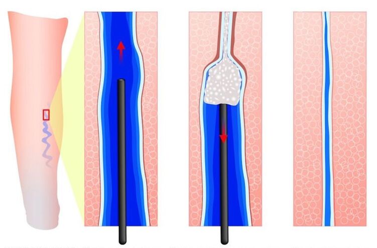 sclerotherapy for the treatment of varicose veins