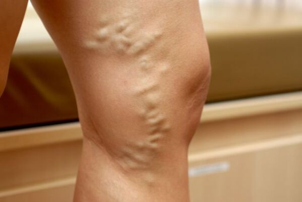 varicose veins on the leg with pelvic varicose veins