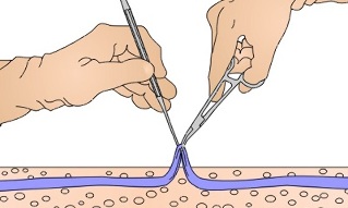 surgery for varicose veins