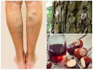 vein treatment on legs folk remedies