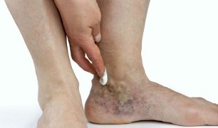 manifestation of varicose veins on the legs