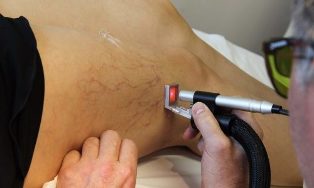 the treatment of varicose veins laser