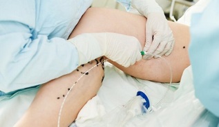 methods for treating varicose veins in women