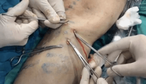 how to perform phlebetomy to remove varicose veins