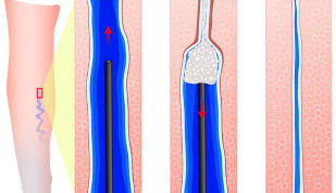 The introduction of the sclerosant during sclerotherapy